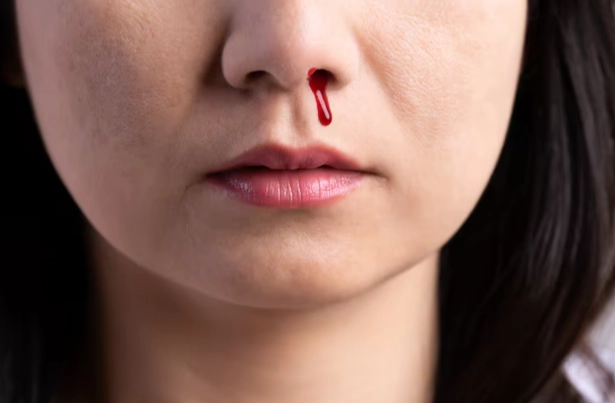 what does a bloody nose dream mean